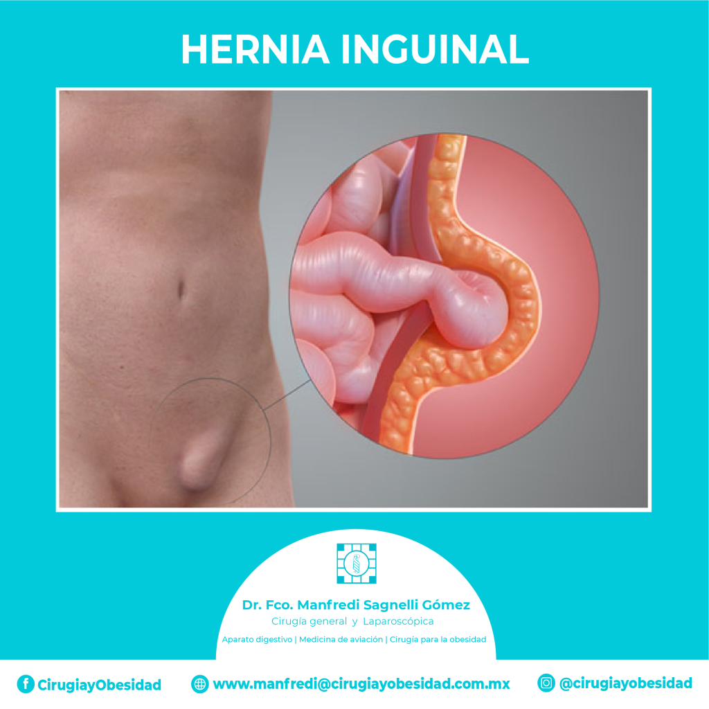 MEDIDAS PARA PREVENIR UNA HERNIA INGUINAL / Tratamiento de Hernias en Guadalajara